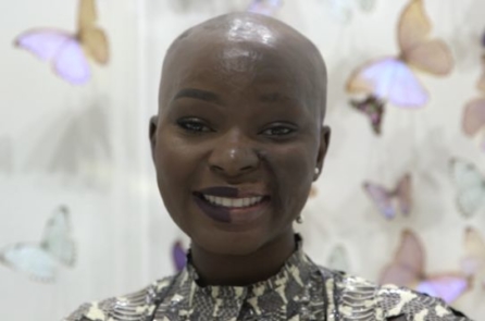 Bị bỏng dầu, cô gái vẫn trở thành ngôi sao trang điểm với nghị lực sống đáng cảm phục