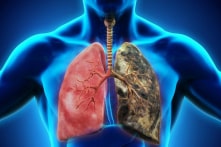 Vì sao nhiều người không hút thuốc mà vẫn bị ung thư phổi?