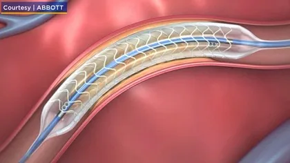 Hình minh họa Stent tự tiêu của hãng Abbott.