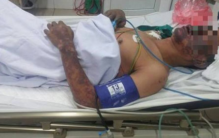 Bị ban hoại tử toàn thân sau khi giết mổ, ăn tiết canh “lợn cắp nách”