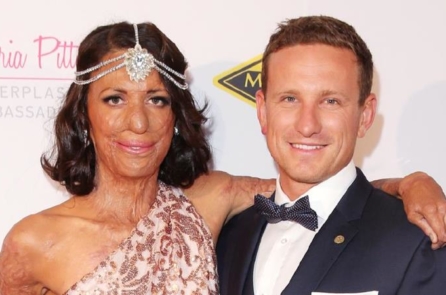 Cô gái bị lửa thiêu biến dạng khuôn mặt tìm được tình yêu đích thực