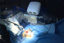 Ca cấy ghép ốc tai đầu tiên có robot hỗ trợ