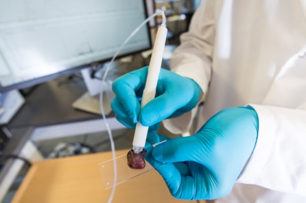 Bút ‘thần kỳ’ có thể phát hiện mô ung thư chỉ sau 10 giây (video)