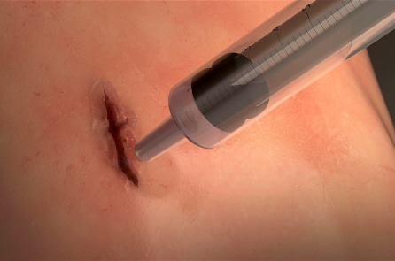 ‘Chất keo’ đột phá giúp cầm máu siêu tốc và lành nhanh vết thương (video)