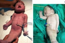 Người phụ nữ Ấn Độ sinh ra em bé “tiên cá” có số phận ngắn ngủi