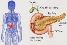Ung thư tuyến tụy và những triệu chứng dễ bị bỏ qua