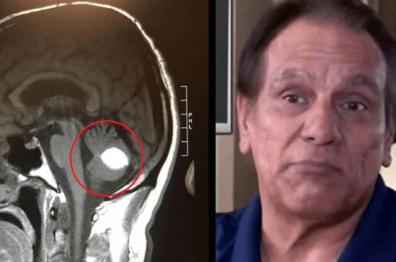 Khối u não đột nhiên biến mất trước lúc phẫu thuật