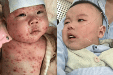 Trung Quốc: Cha mẹ tuyệt vọng khi con bị liệt, điếc vì tiêm vắc-xin quá hạn