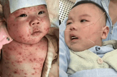Trung Quốc: Cha mẹ tuyệt vọng khi con bị liệt, điếc vì tiêm vắc-xin quá hạn