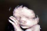 baby-in-ultrasound