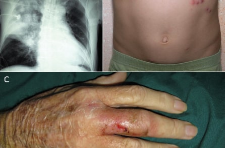 Cảnh báo bệnh ăn mòn cơ thể Whitmore tái bùng phát tại Việt Nam