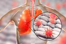 Virus corona có thể trốn sâu trong phổi sau khi bệnh nhân hồi phục