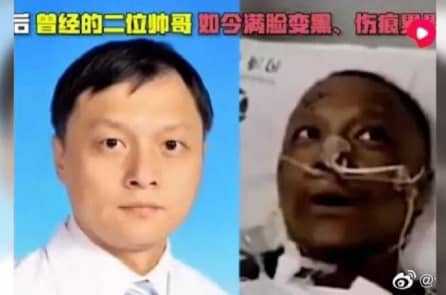 COVID-19 tổn hại gan thế nào mà da chuyển màu đen?