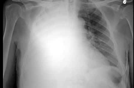 Hai người Việt muốn hiến phổi cho bệnh nhân 91