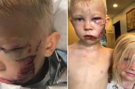 Cậu bé 6 tuổi cứu em gái khỏi chó cắn, bị 90 mũi khâu trên mặt