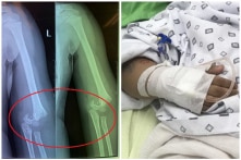 Hà Nội: Bé gái 5 tuổi ngã gãy tay trong giờ học, nguy cơ bị liệt