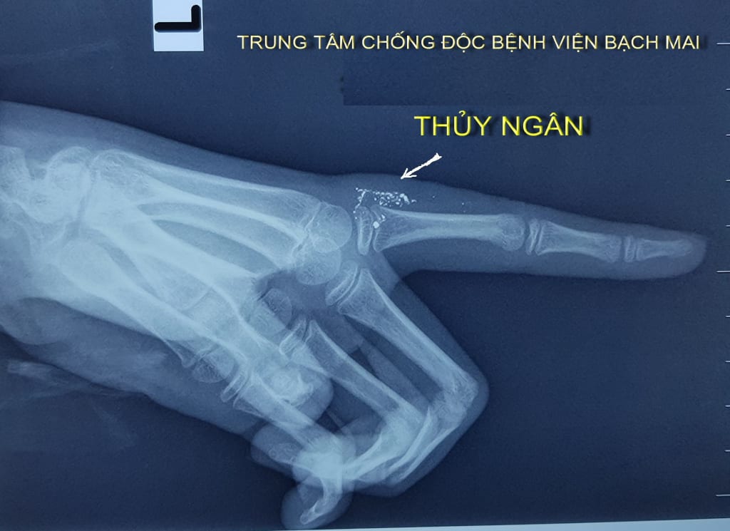 nhiem doc thuy ngan