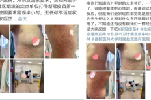 Người đàn ông bị sốt cao và nổi mẩn đỏ sau khi tiêm vắc-xin Trung Quốc