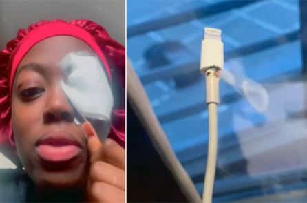 Nữ sinh bị mù một phần sau khi dây sạc iPhone phát nổ