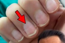 Nếu móng tay xuất hiện dấu hiệu này có thể bạn đã bị nhiễm Covid