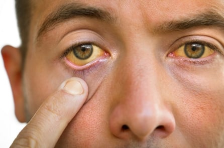 8 dấu hiệu cho thấy bạn có thể đang mắc bệnh gan