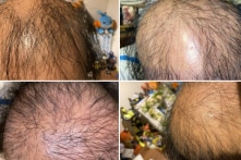 Hàn quốc, Nhật: Xuất hiện hiện tượng rụng tóc sau khi tiêm vắc-xin COVID-19