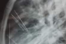 7 cây kim gỉ sét ghim trong lồng ngực một bệnh nhân