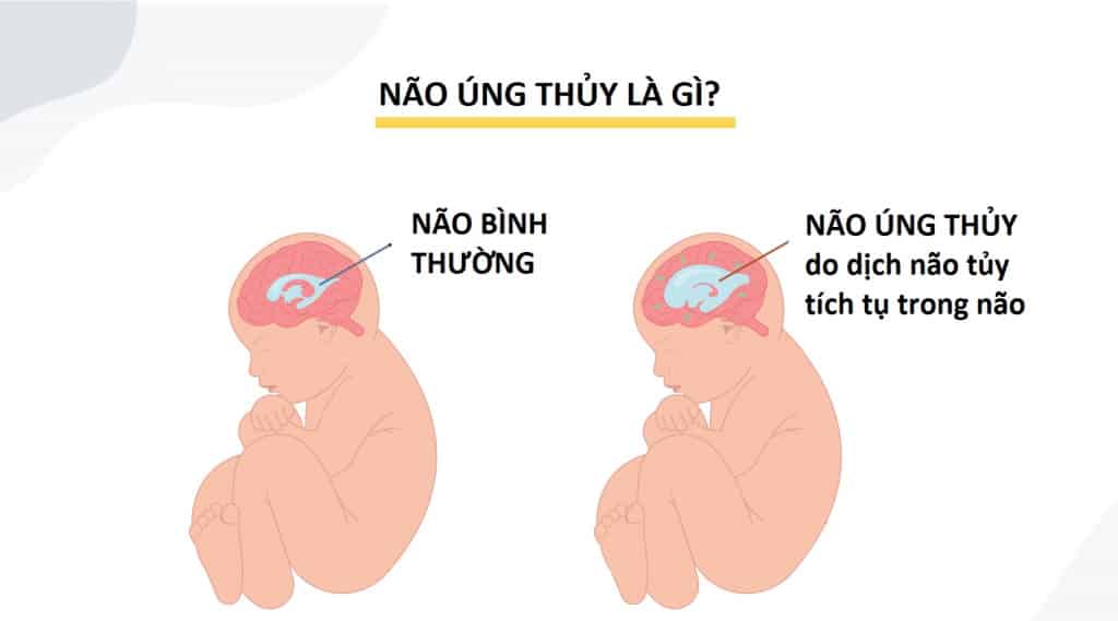 không có não