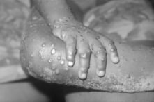 National Pulse: Viện Virus học Vũ Hán nghiên cứu virus đậu mùa khỉ cách đây không lâu