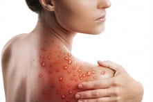 Mỹ tuyên bố bệnh đậu mùa khỉ là “tình trạng sức khỏe cộng đồng khẩn cấp” toàn quốc
