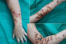 Bé trai 10 tuổi bị loét sâu trên cánh tay do sứa đốt