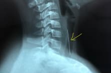 Gắp cây kim dài hơn 4cm mắc trong đường thở của bé trai 10 tuổi