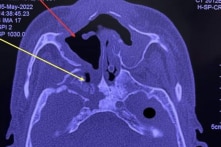 Các bệnh viện Việt Nam báo cáo về số ca hoại tử xương hàm tăng sau COVID-19