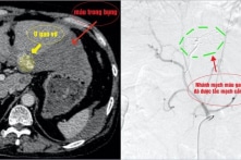 Long An: Đang ăn cơm, người đàn ông bị chảy máu xối xả trong ổ bụng