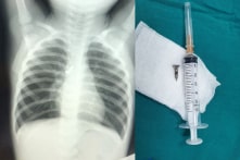 Tai nạn cảnh báo: Bé trai 22 tháng tuổi bị đinh vít găm vào phế quản