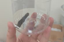 Nhánh cây 14 năm ‘sống’ trong phổi chàng trai người H’mông