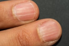Móng tay xuất hiện đường vân dọc cảnh báo điều gì?