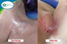 Bé gái 19 tháng tuổi bị bỏng do hóa chất tẩy dầu mỡ