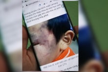 Hà Tĩnh: Bé trai 4 tuổi bị con gái của giáo viên đánh bầm tím