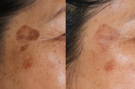 Một phụ nữ bị nhiễm trùng nặng khi trị sạm, nám bằng thuốc chứa axit