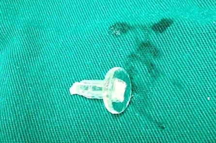 Bé trai lớp 6 sốt, khó thở nặng vì nuốt phải đầu bút bi
