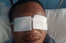 Tết Quý Mão: Số ca khám, cấp cứu do pháo nổ tăng 34% so với năm trước