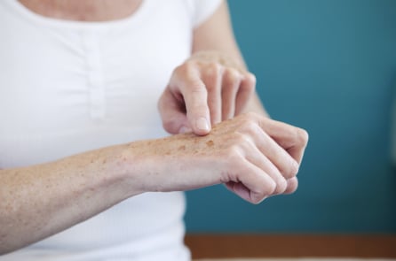 Tuổi tác không phải là nguyên nhân duy nhất gây ra các đốm đồi mồi