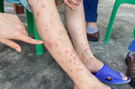Hà Tĩnh: Bọ chét hút máu khiến 126 người bị viêm da dị ứng