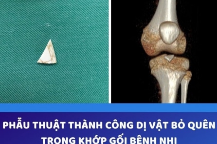 Bác sĩ phẫu thuật lấy ra mảnh sành nằm trong khớp gối bé gái 2 năm