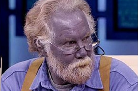 Paul Karason – người đàn ông da trắng chuyển thành da xanh vì uống thực phẩm chức năng