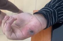 Điện Biên phát hiện 3 ổ dịch bệnh than trên người, Bộ Y tế vào cuộc