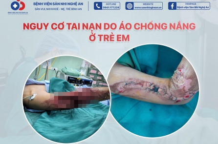 Trẻ bị gãy tay lộ xương, mất phần mềm lớn do áo chống nắng