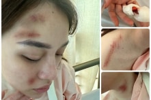 Cô gái mới sảy thai ‘tố’ bạn trai là công an quận hành hung bầm tím khắp người
