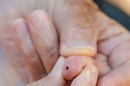 Khuyến cáo không chọc máu tai, đầu ngón tay để chữa tai biến mạch máu não